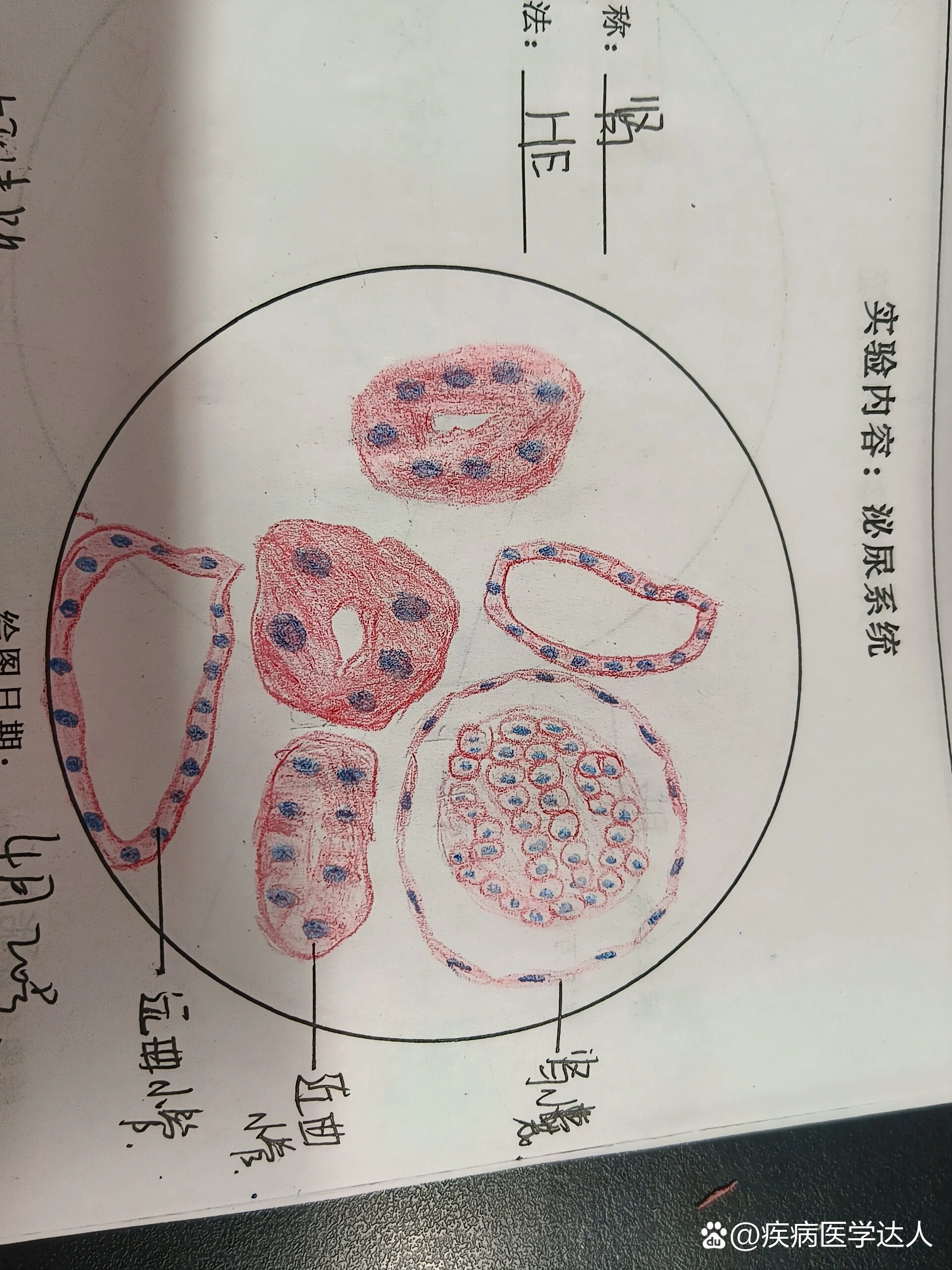 慢性肾小球肾炎手绘图图片