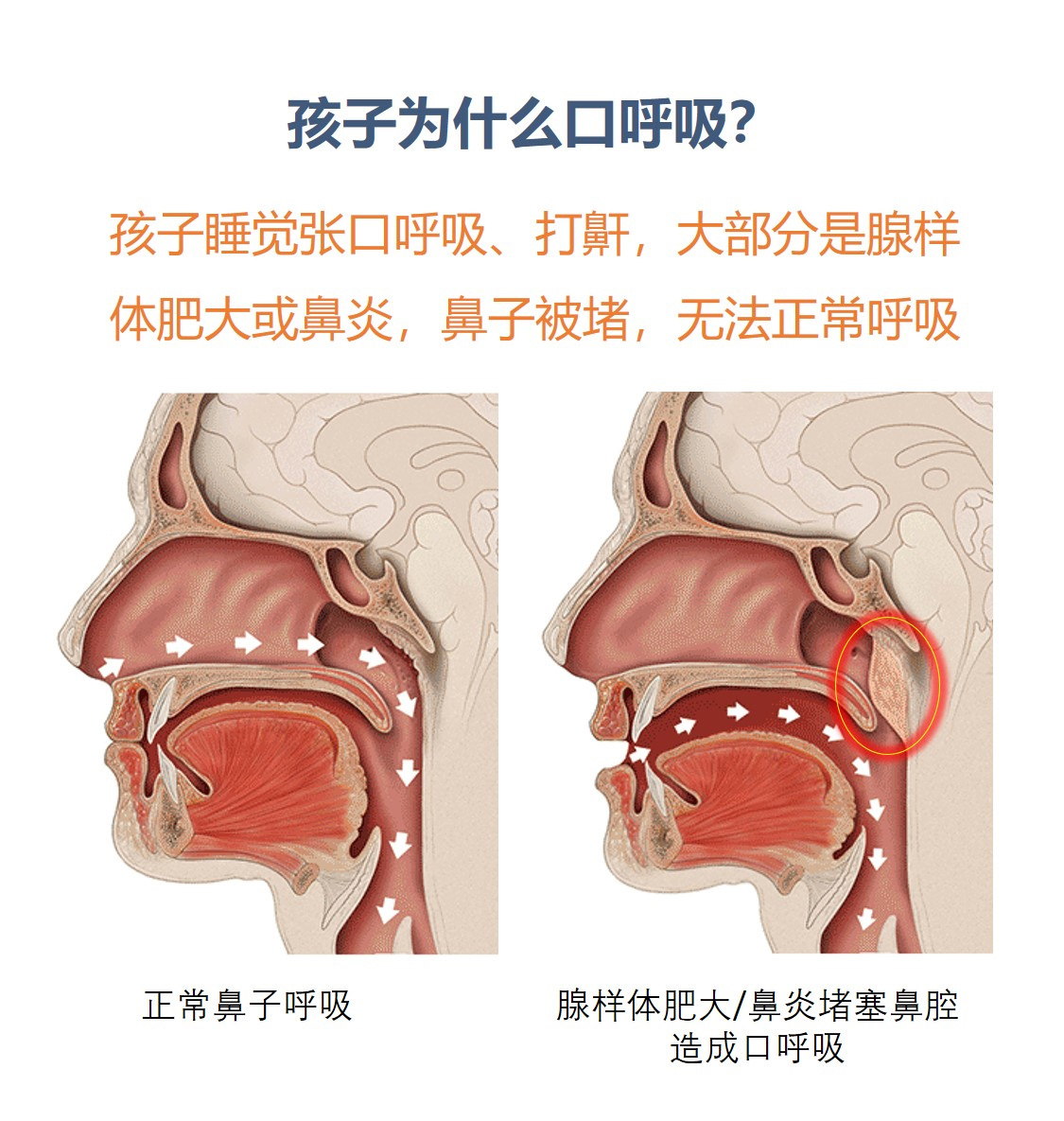 大部分是腺样体肥大或者鼻炎被堵,无法正常呼吸	🙌 口呼吸