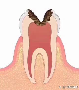 牙神经腐烂发臭图片图片