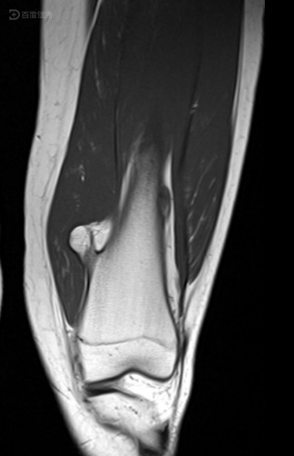 股骨软骨瘤图片