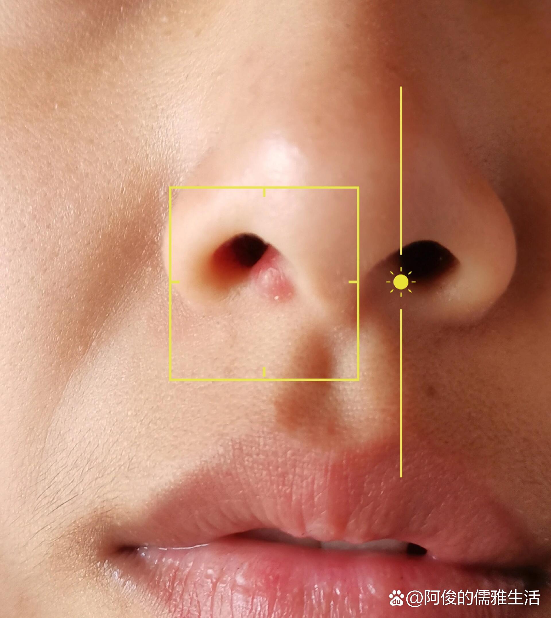 怎么有人痘痘长在鼻孔里啊!