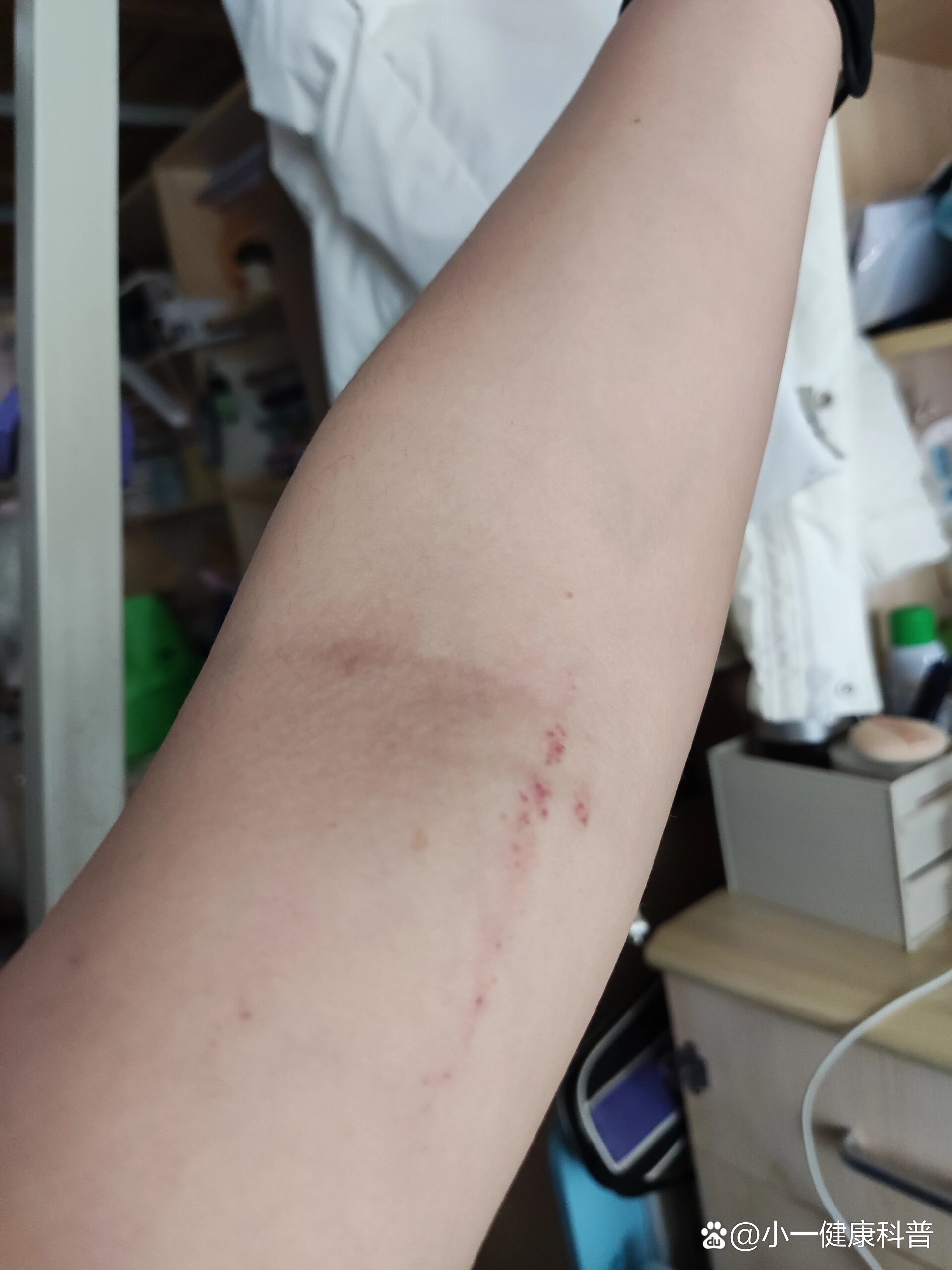 午睡起来发现手臂上有红点点汇聚成一条线