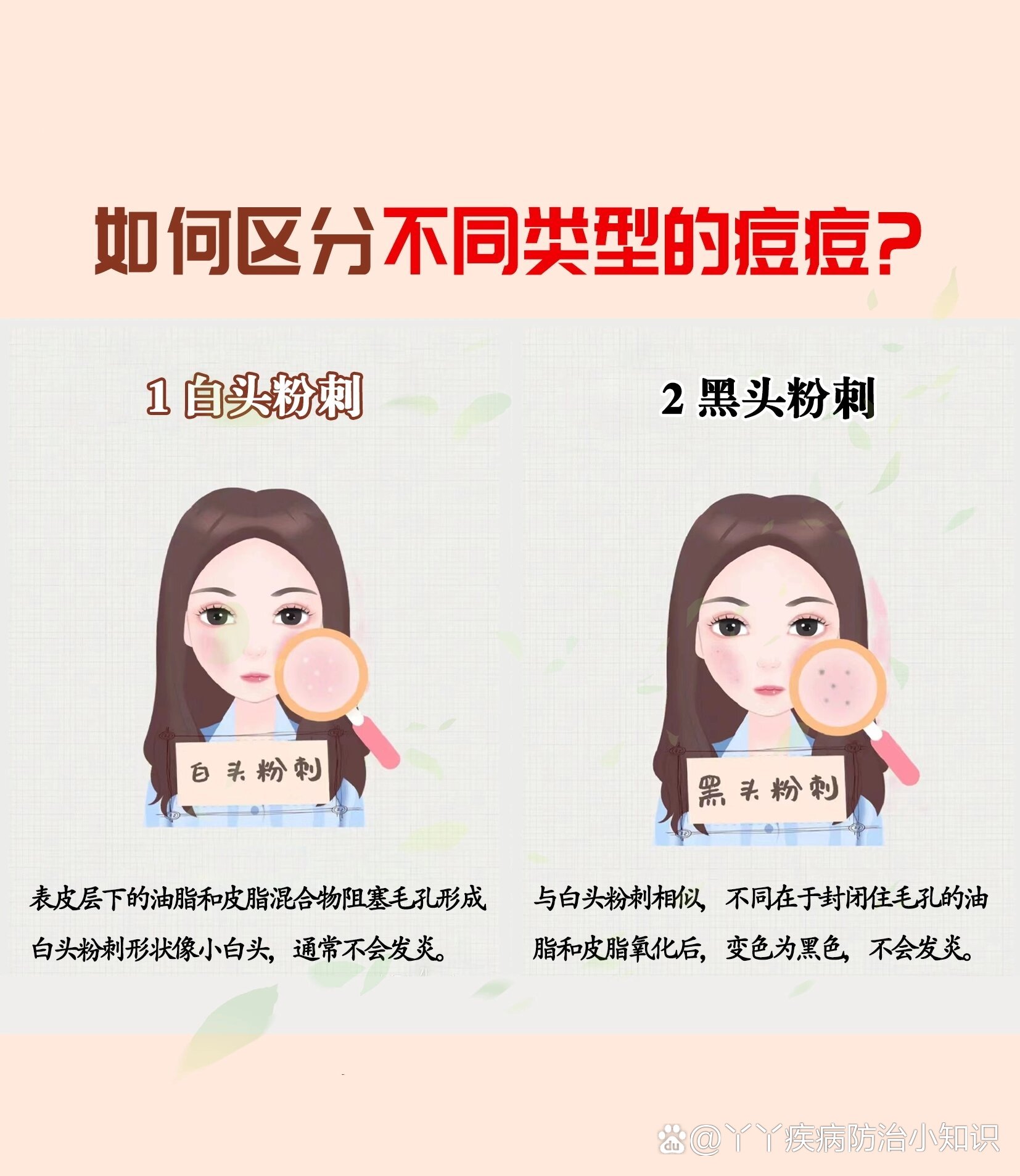 白头粉刺和黑头粉刺区别