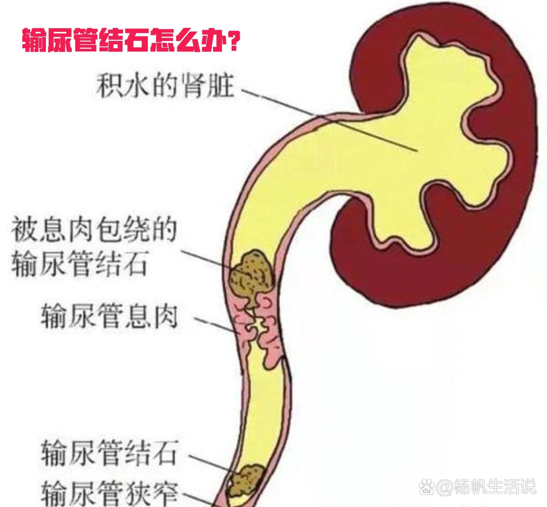 输尿管结石怎样排出图片