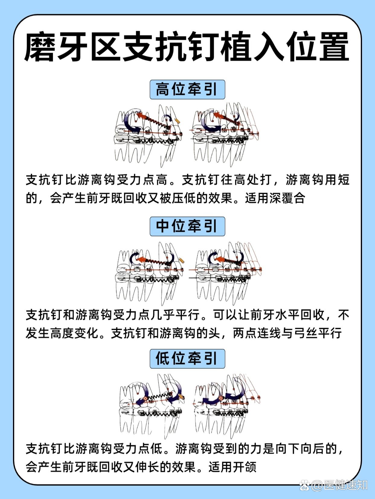 磨牙区支抗钉植入位置