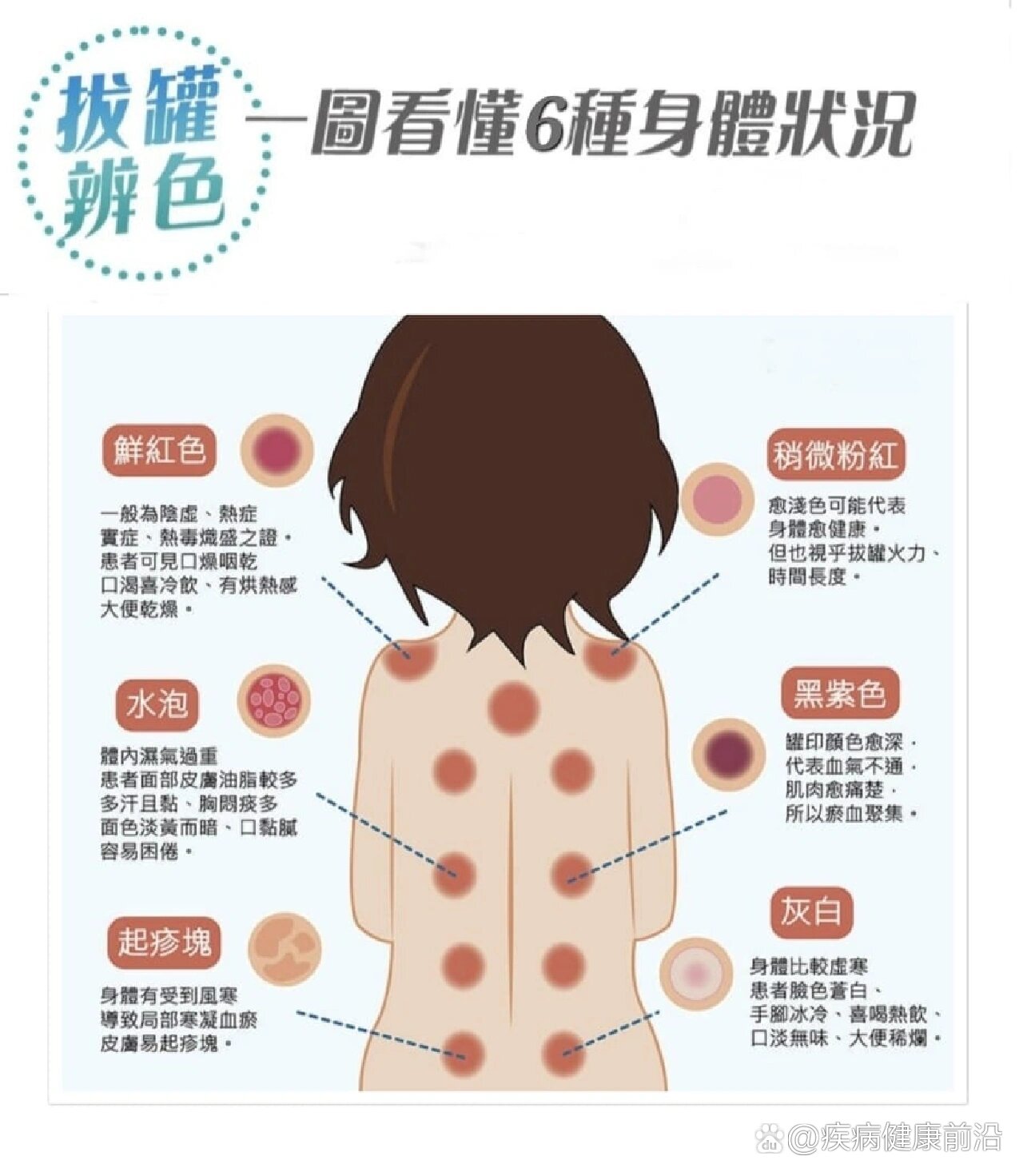 拨罐六种颜色了解身体状况