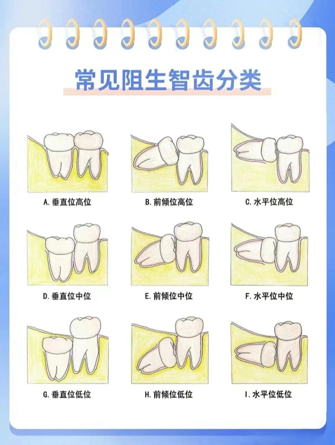 智齿阻生分类示意图图片