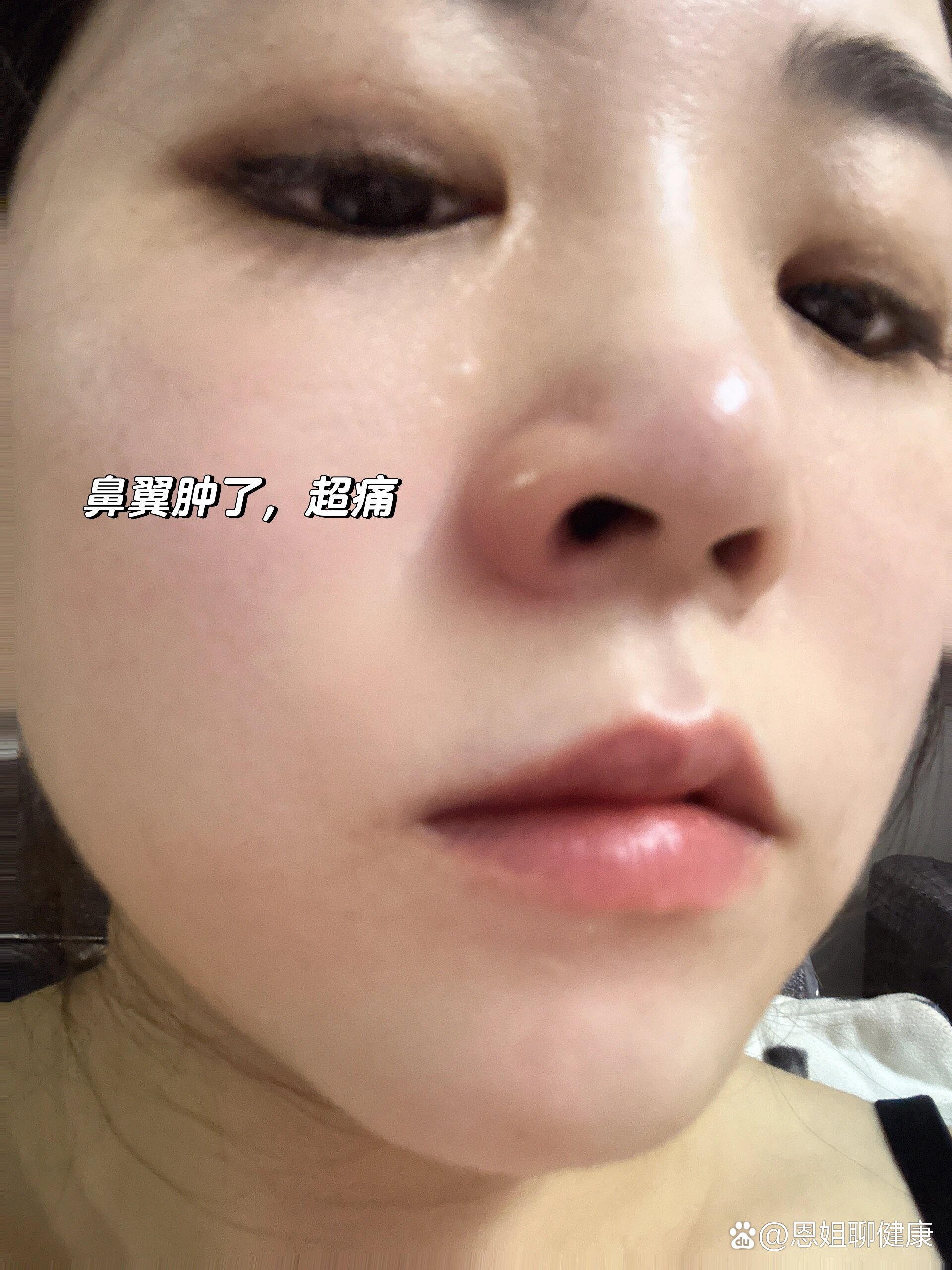鼻翼突然肿了,超级痛.