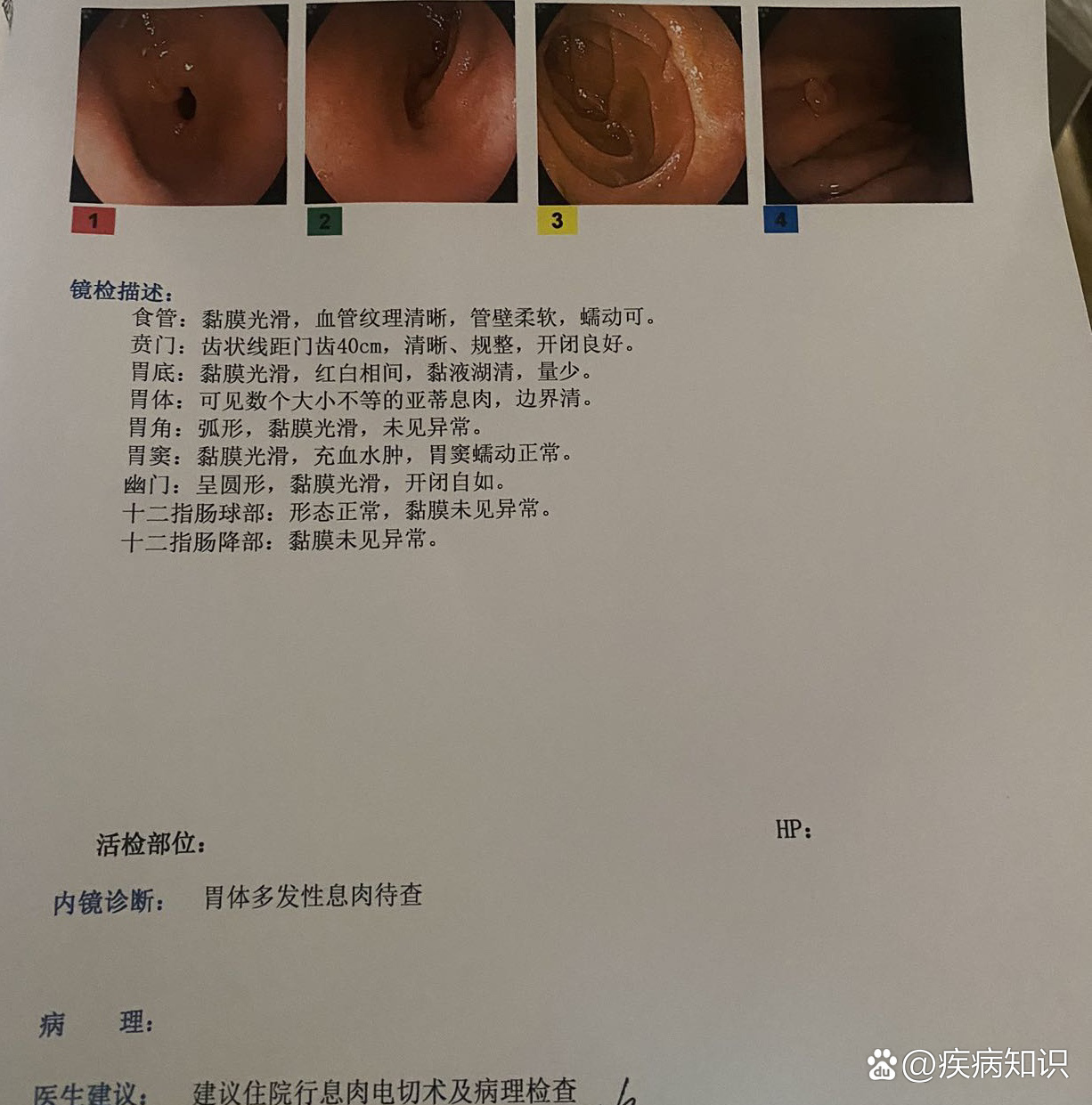 胃息肉切除