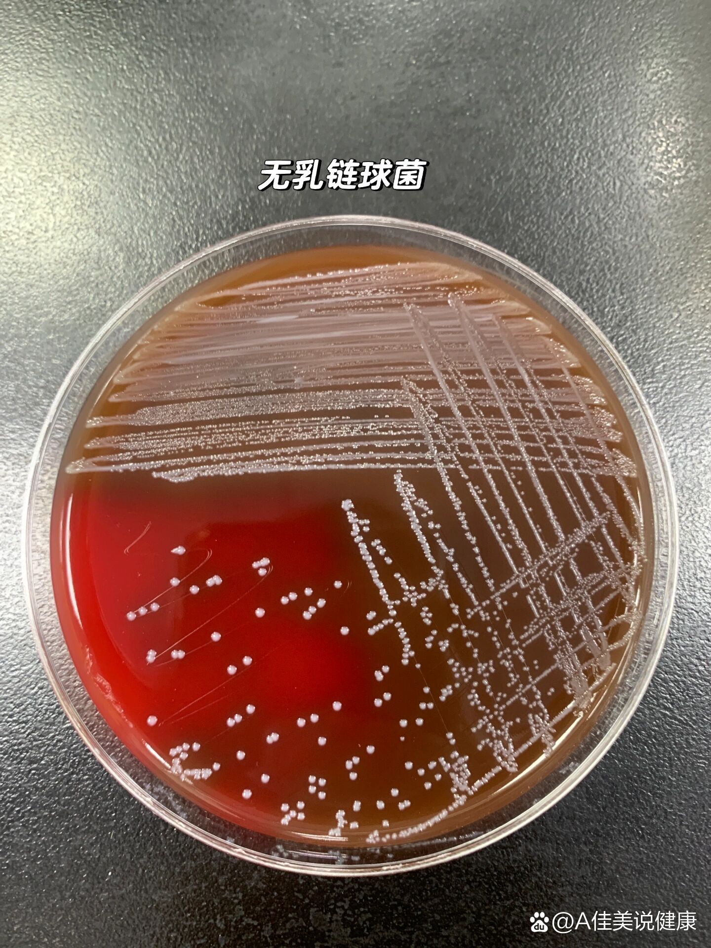 >新生儿脑脊液标本在血平板上培养24小时的呈草绿色溶血的无乳链球菌