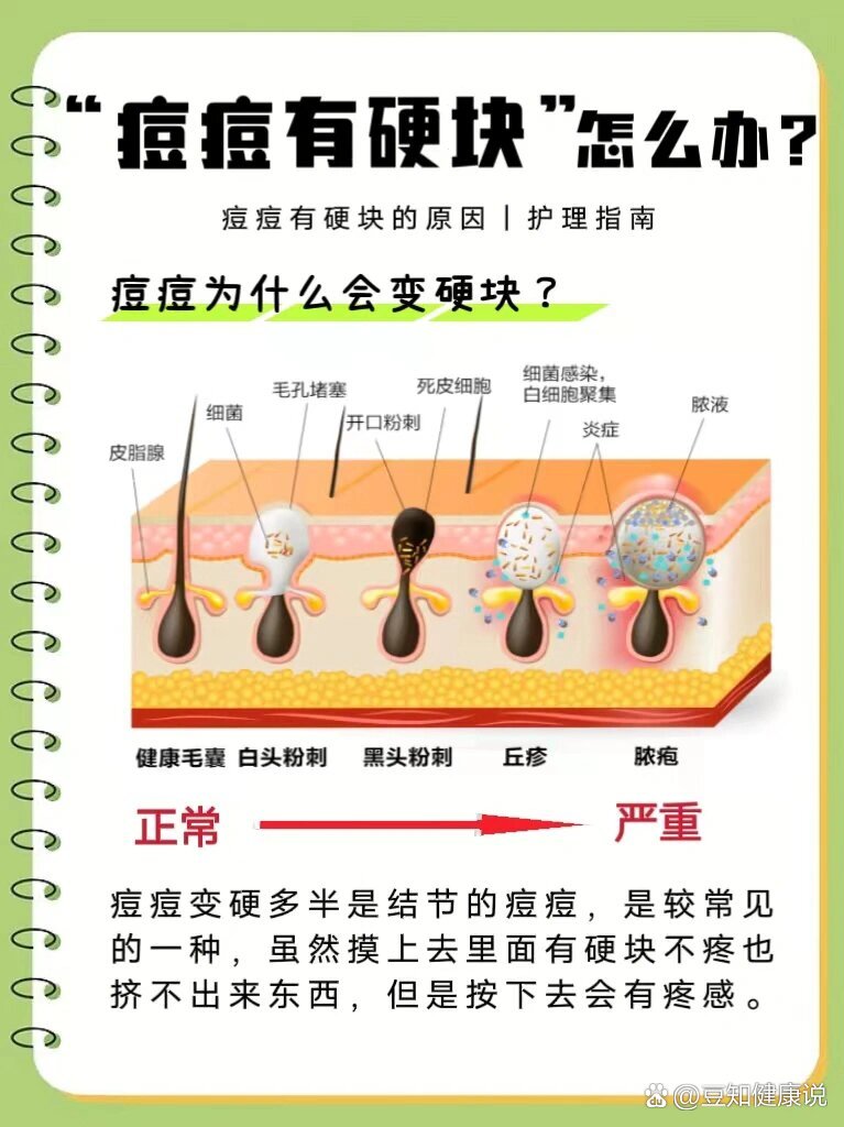 痘痘红肿硬块快速去除图片