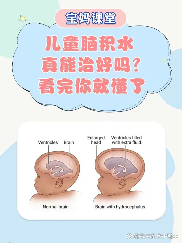 婴儿脑积水能治好吗图片