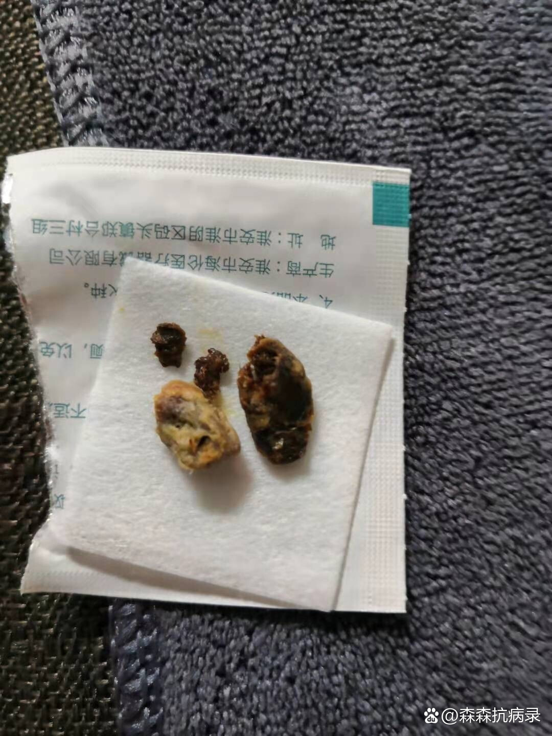  br>第一次采耳的小朋友掏出来这么大的耳结石,要是感觉耳朵不通透