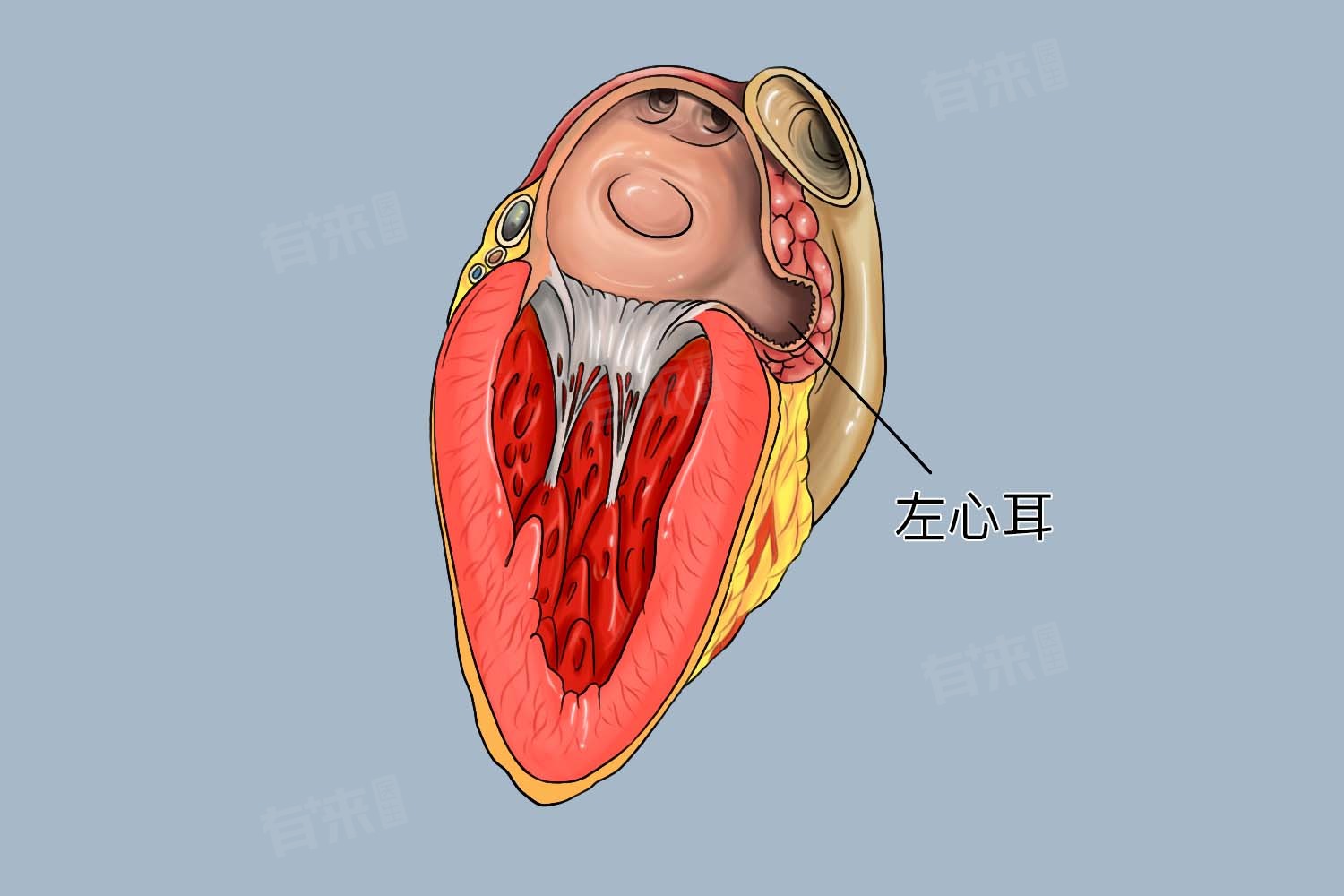 左心耳封堵术是什么意思