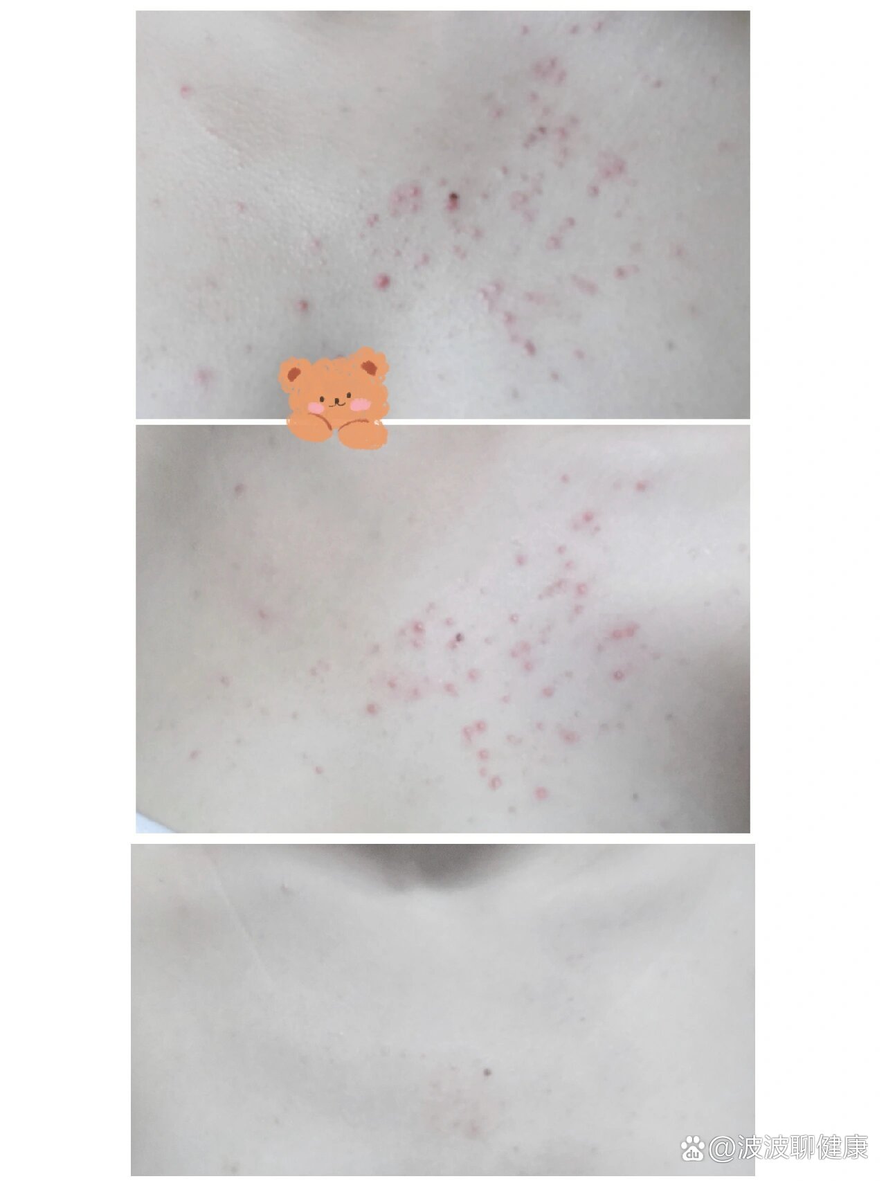 马拉色菌毛囊炎