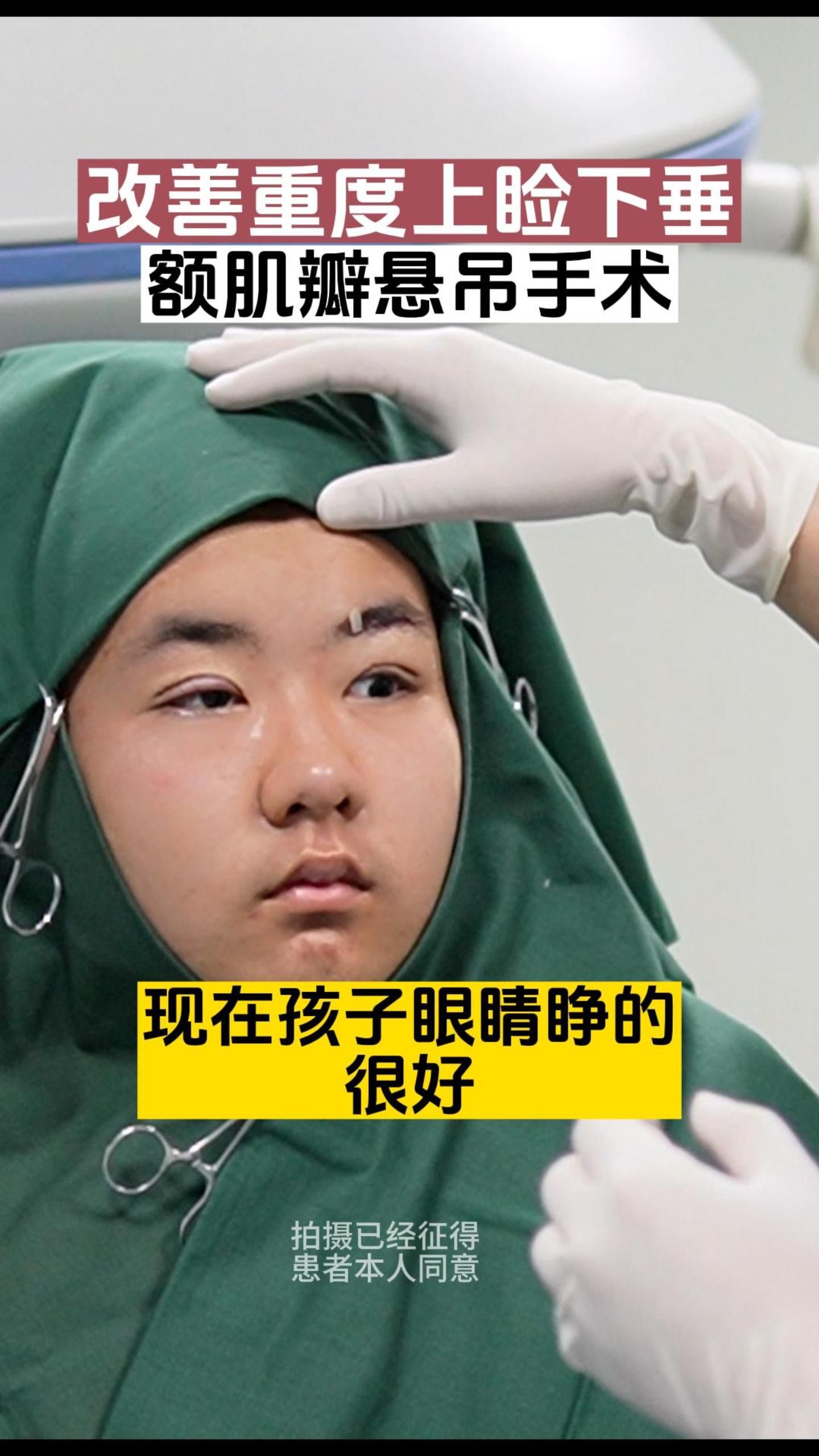 额肌瓣悬吊手术术后即刻,重度上睑下垂改善手术术后即刻