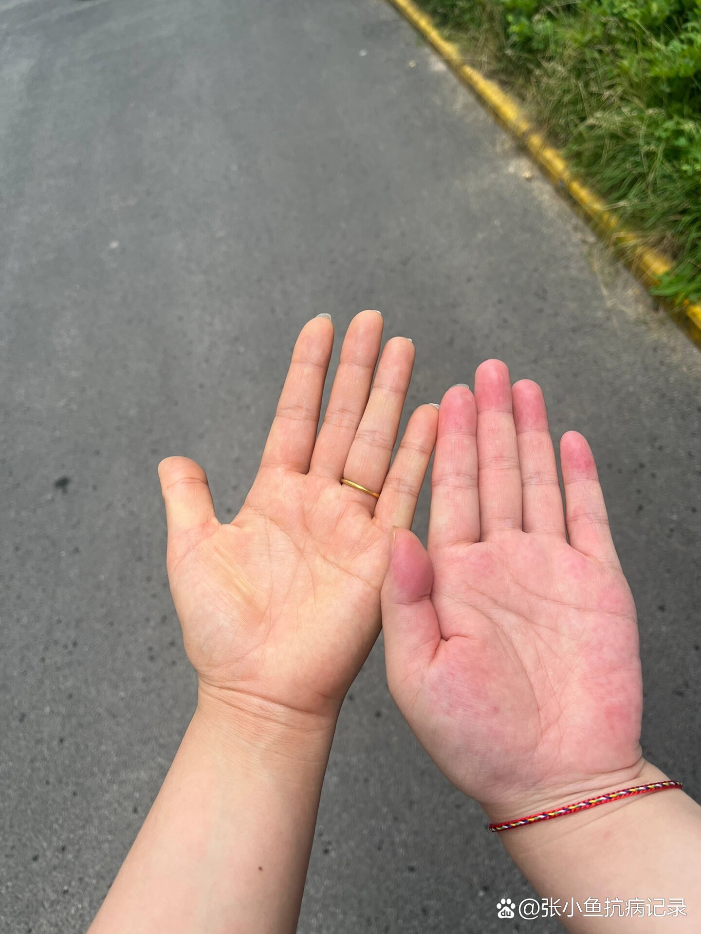 手心发黄,肝功检查都正常什么原因?