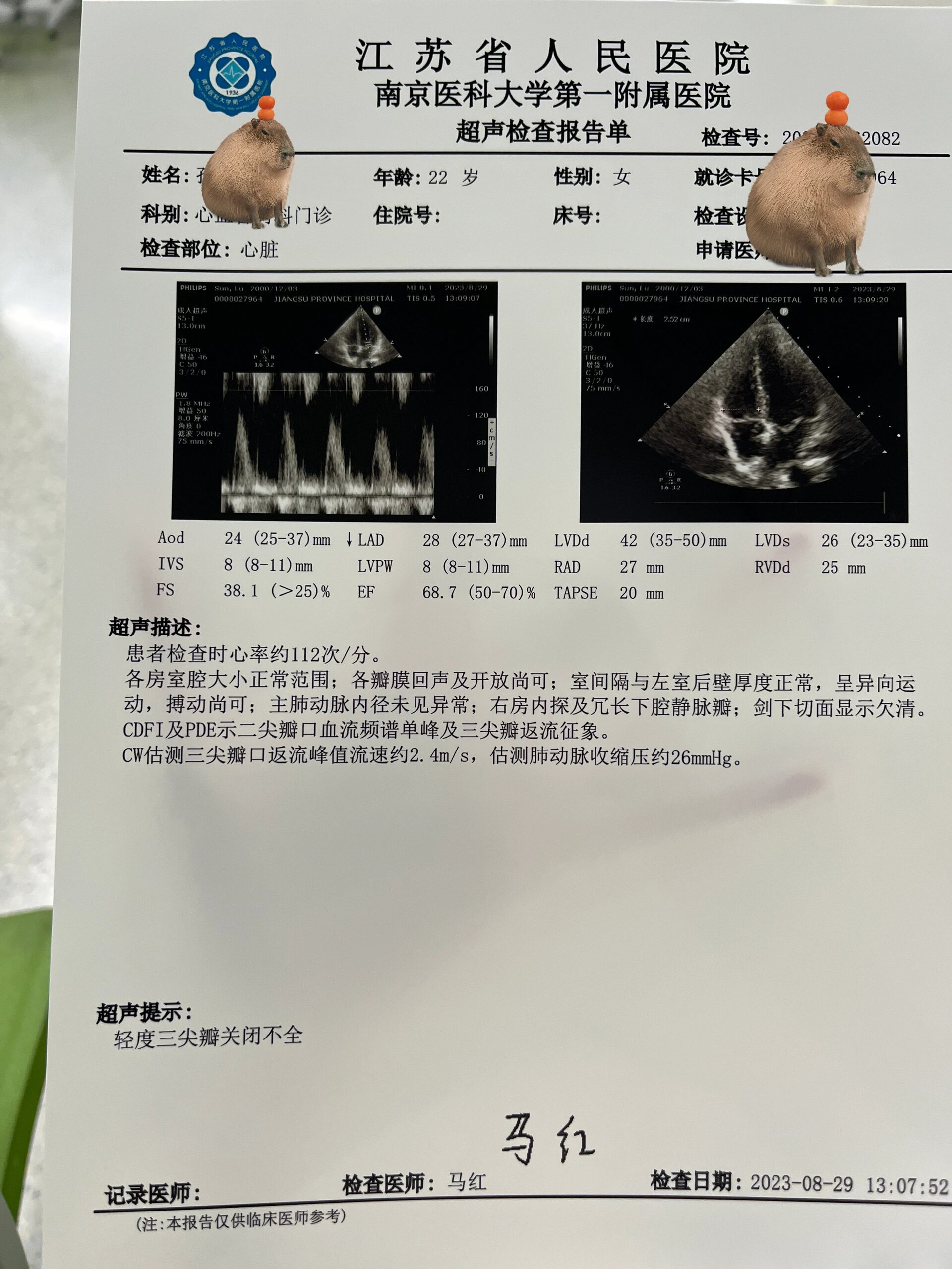 三尖瓣关闭不全图片