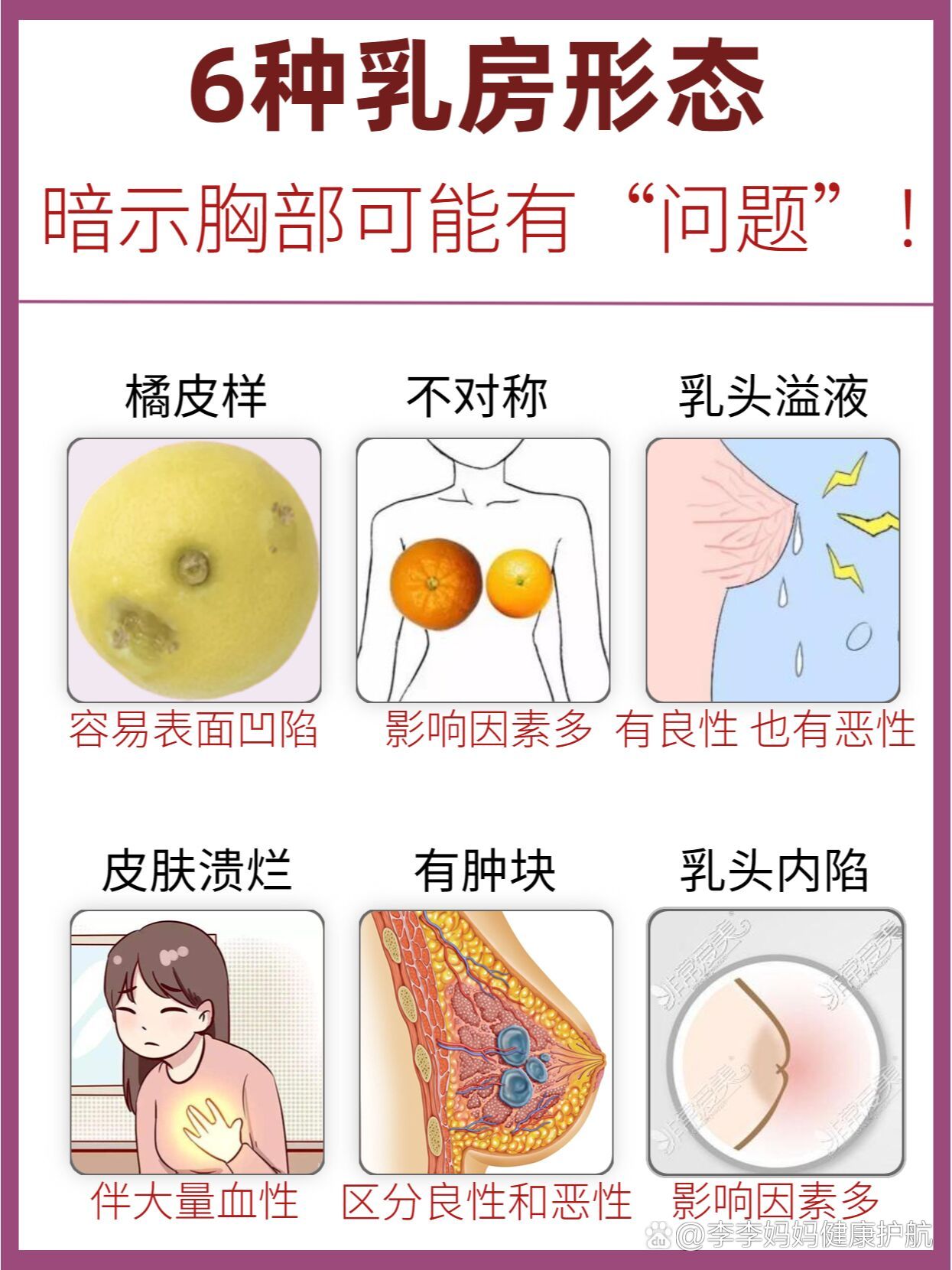 橘皮样乳房早期症状图片