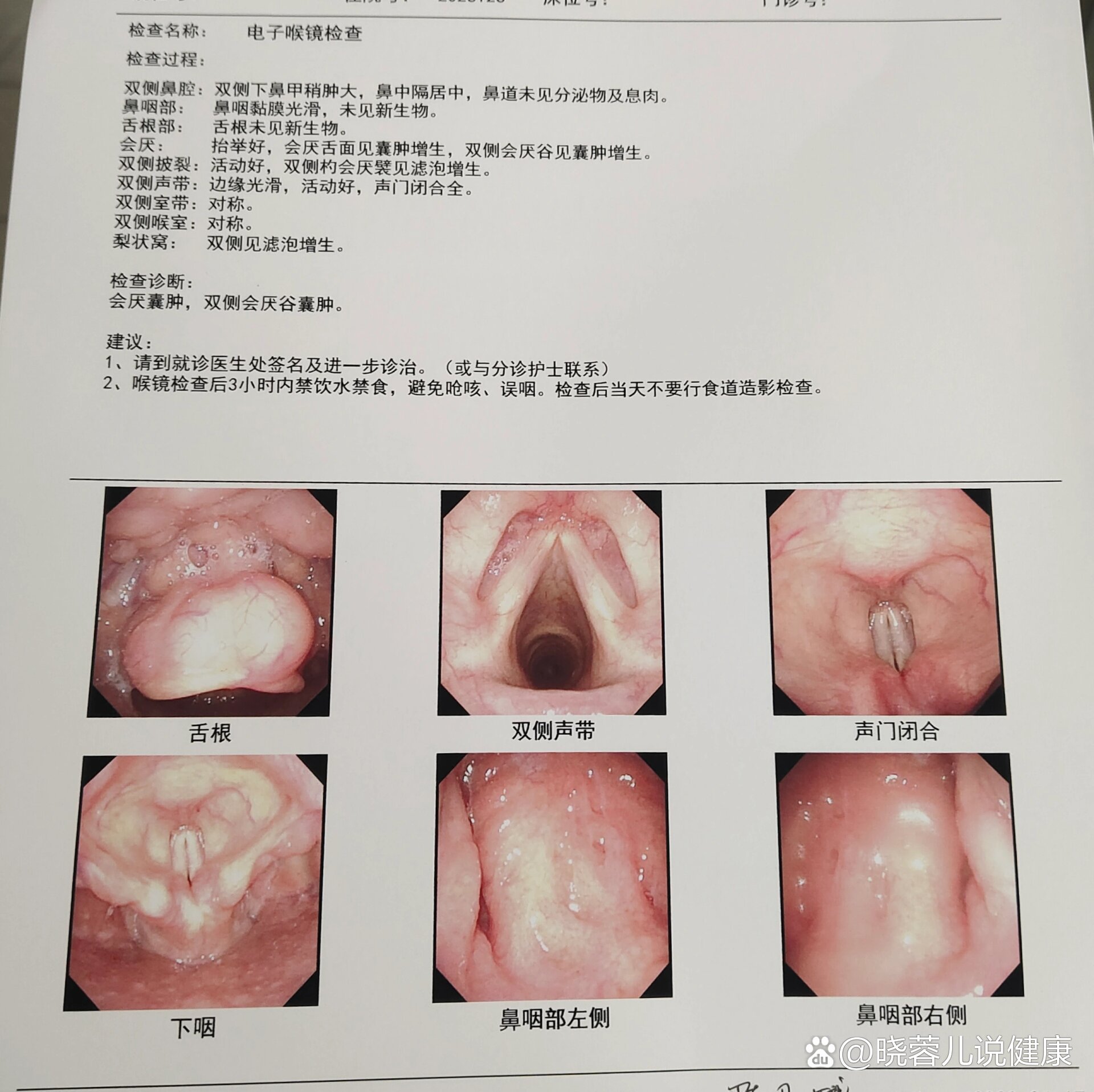 咽喉囊肿严重吗图片