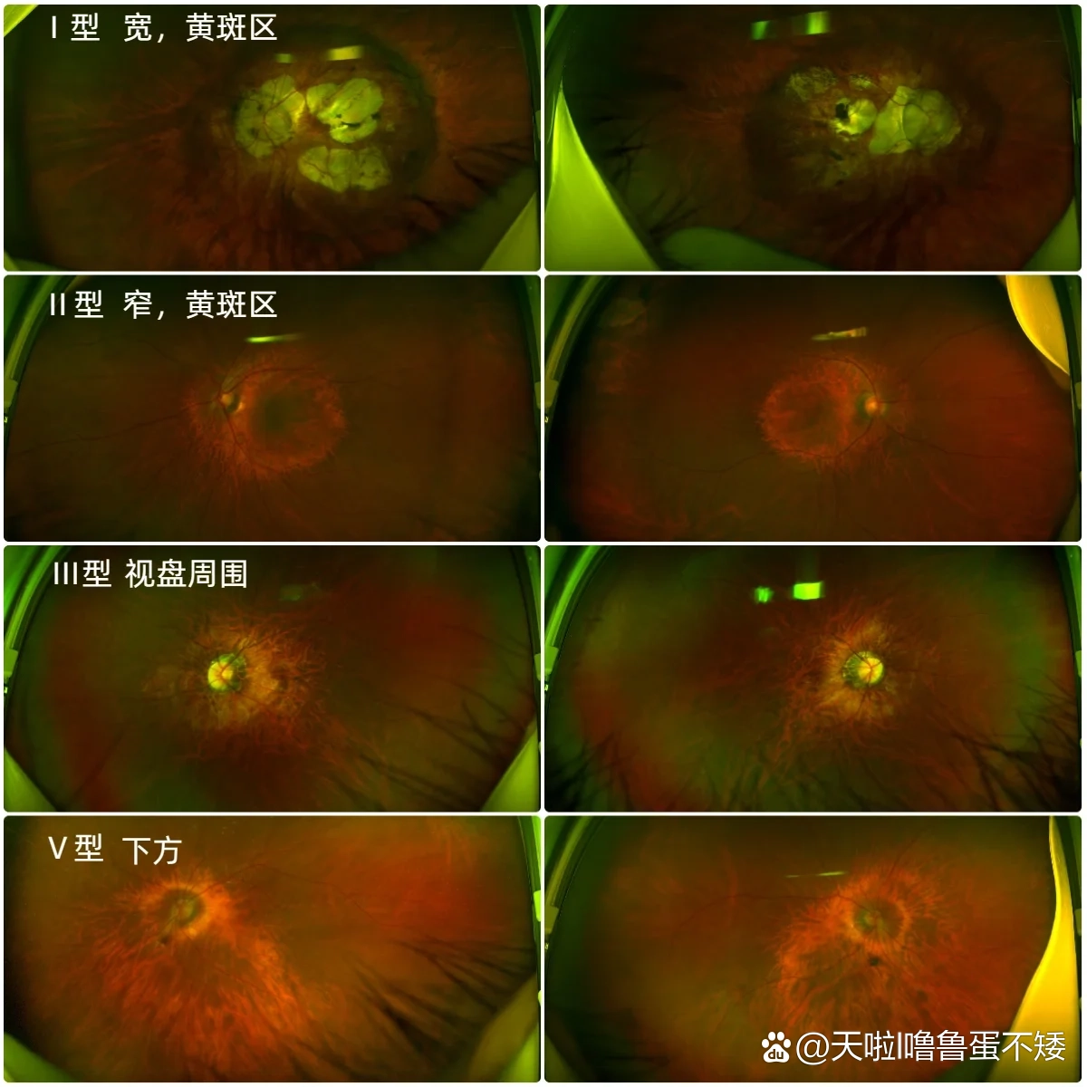 结节性表层巩膜炎图片图片