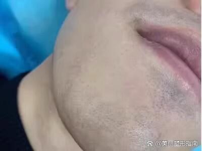 去胡青9915699215去除后能保持多久?
