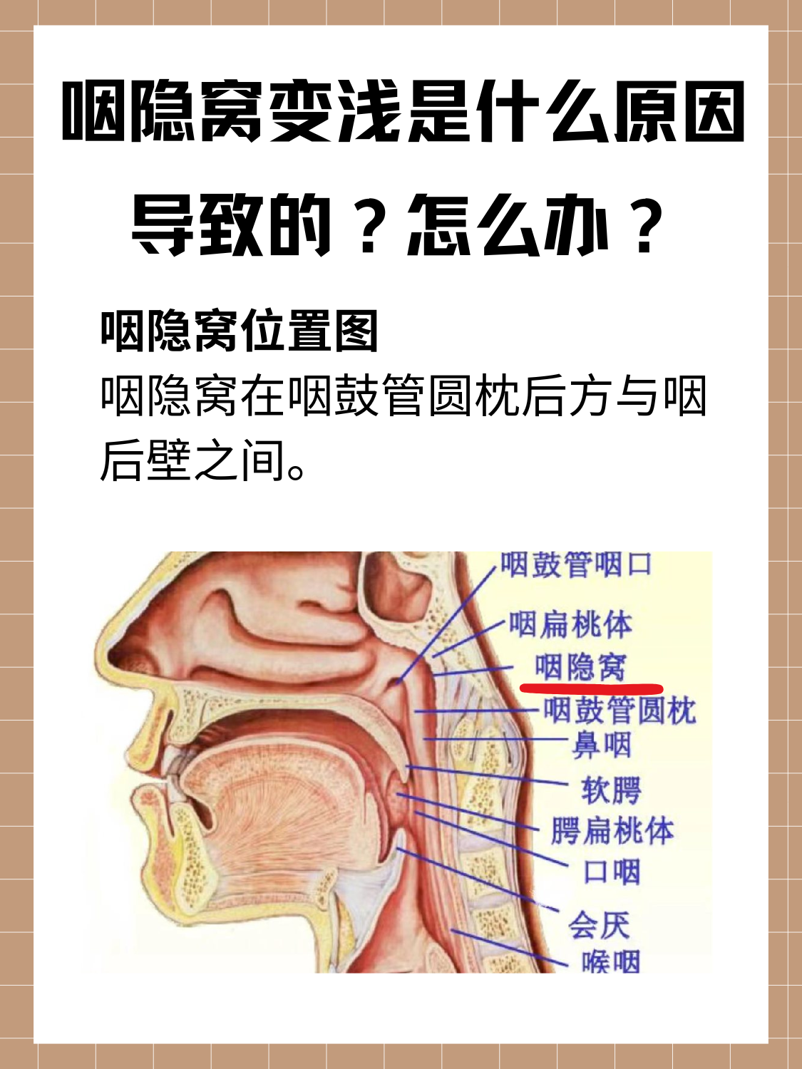 腭扁桃体隐窝图片图片