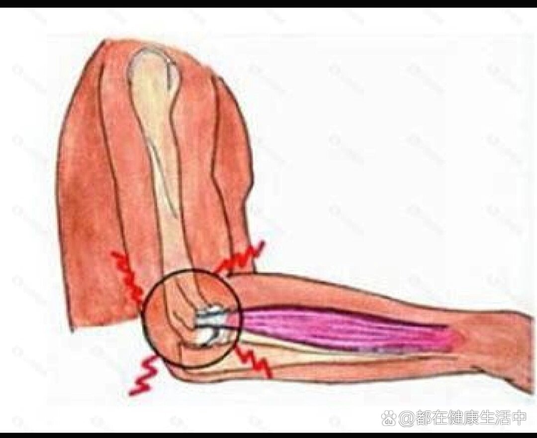 右肱骨外上髁炎图片