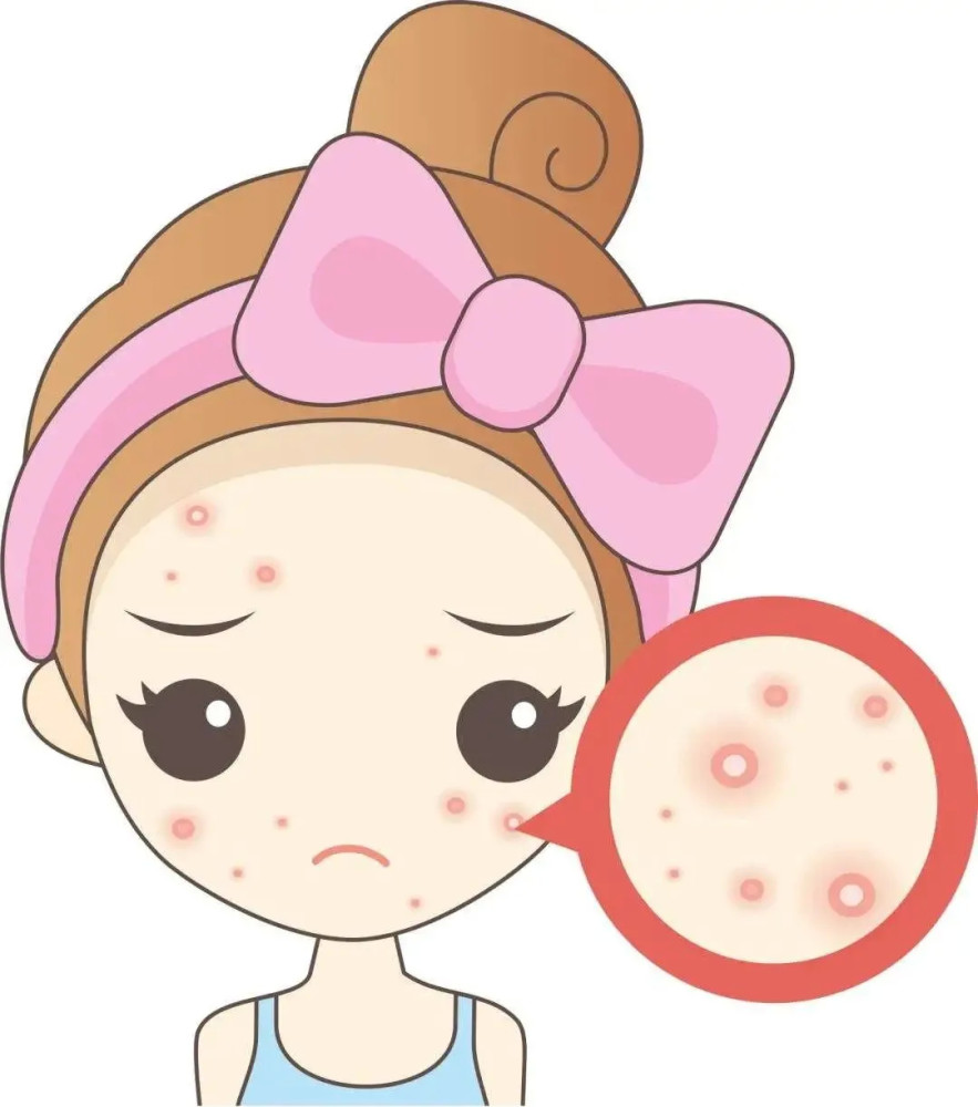 长痘是让人比较难受的事情,用一些药物痘痘清理不干净不说