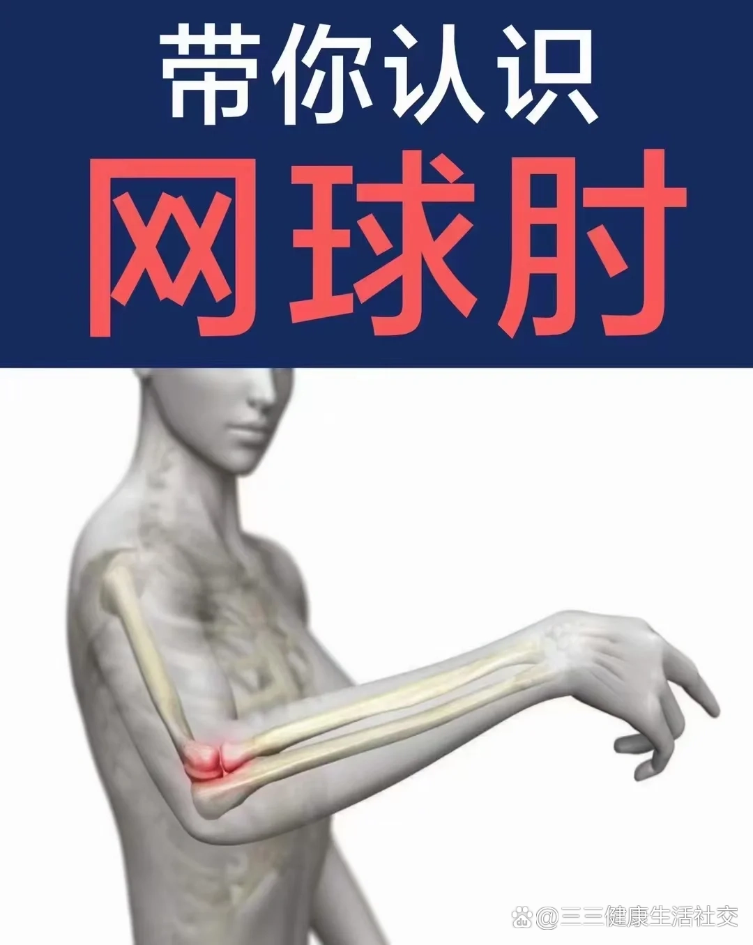 97网球肘97