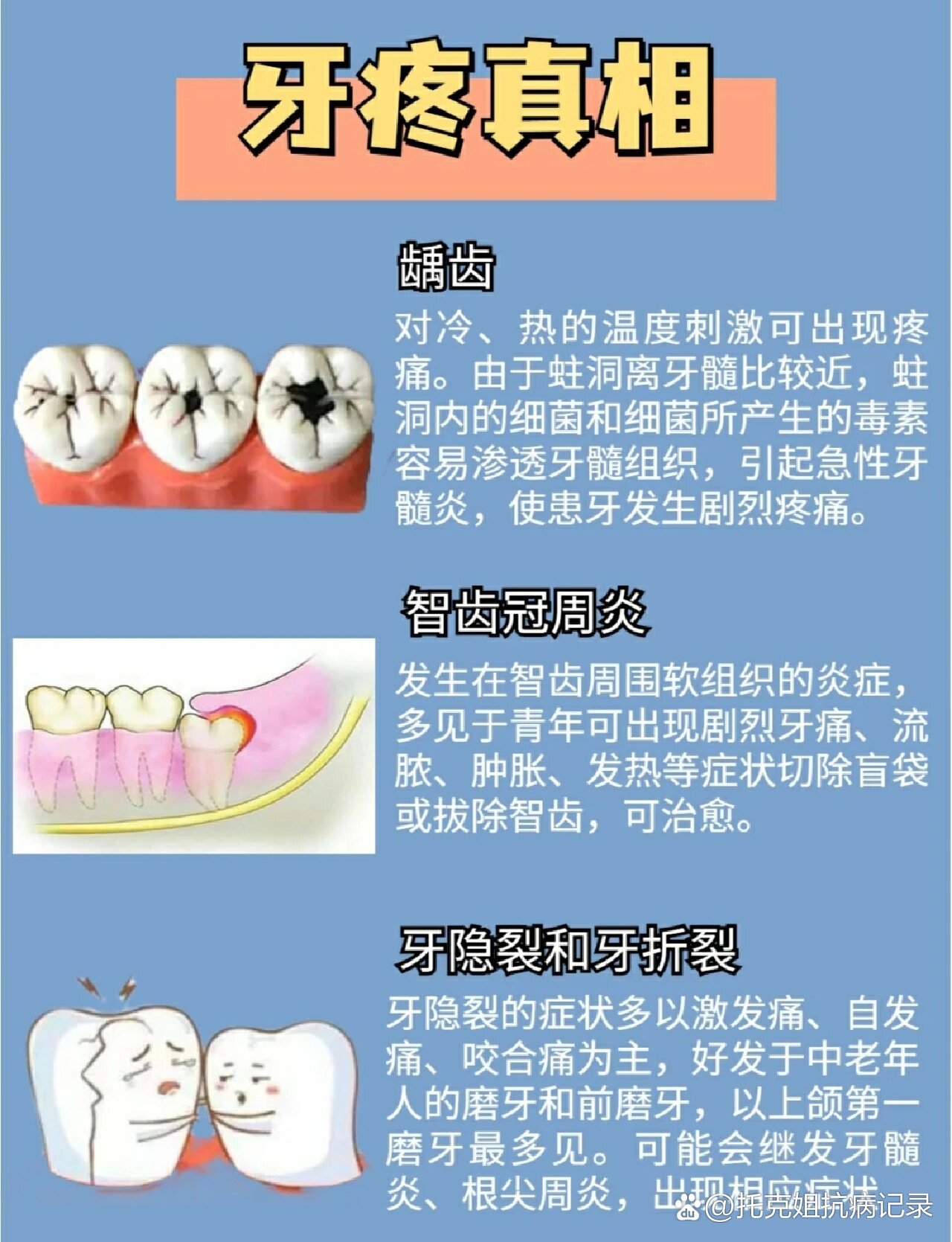 救命98一半被牙龈包裹的智齿