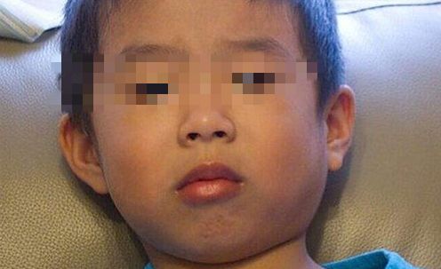 出现腮腺肿大症状,往往是化脓性腮腺炎引起的