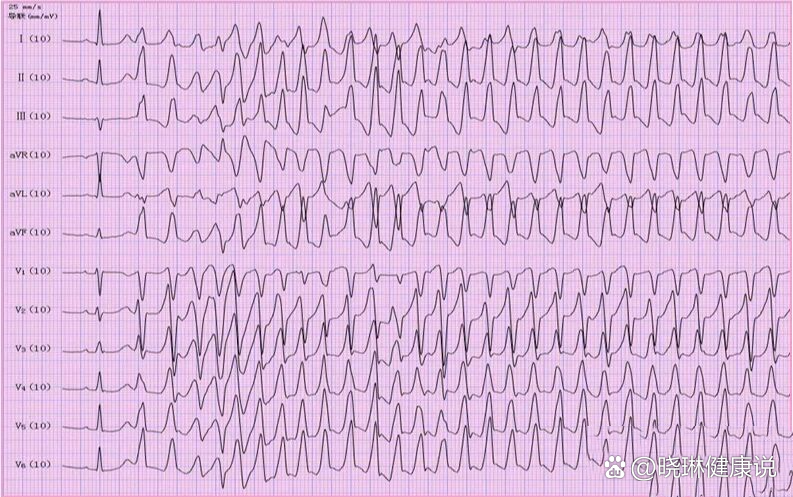 室性尖端扭转心电图图片