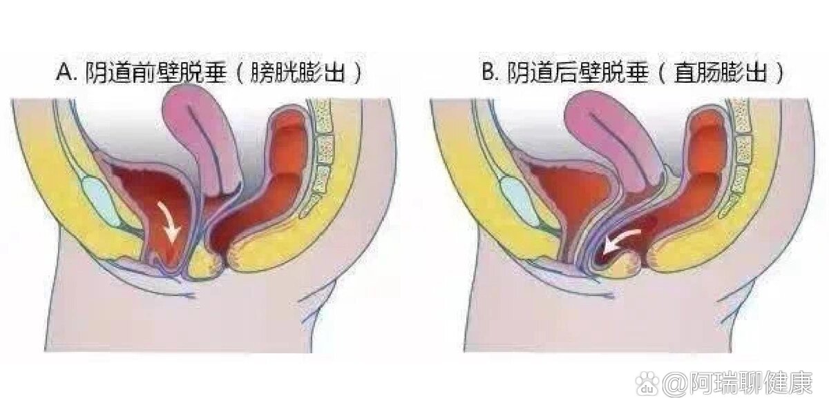 直肠膨出图片图片