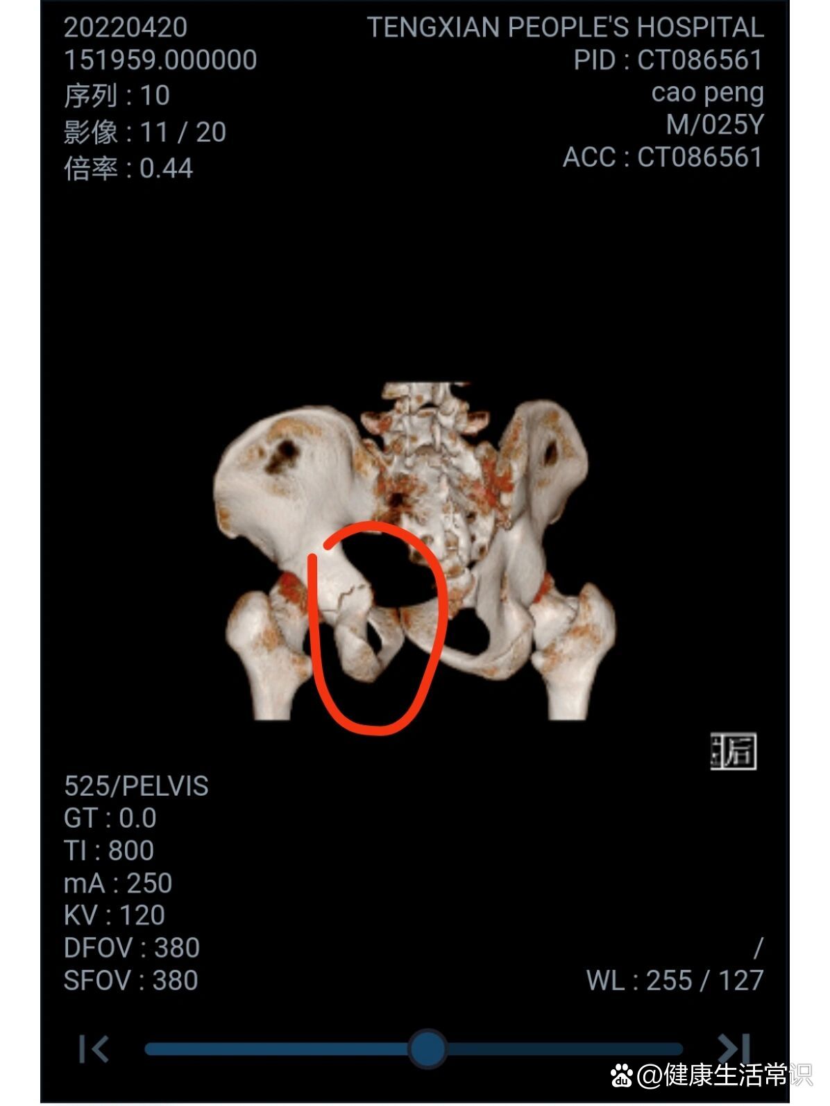 髋臼切迹图片