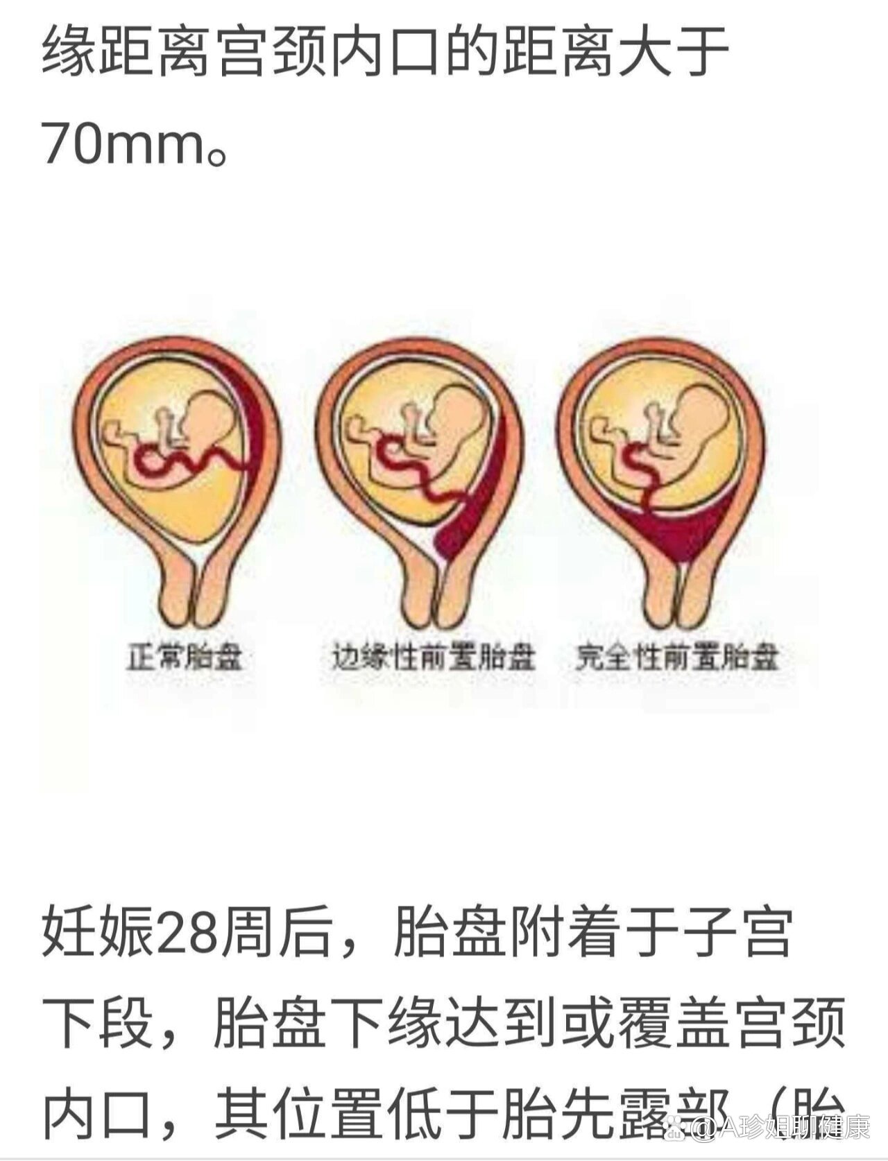 宫颈内口松弛图片图片