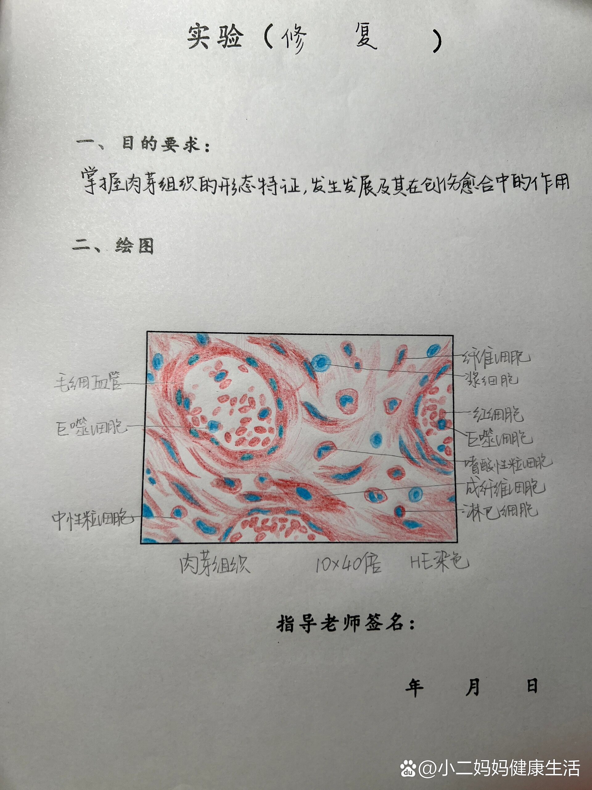 绒毛膜癌病理手绘图图片