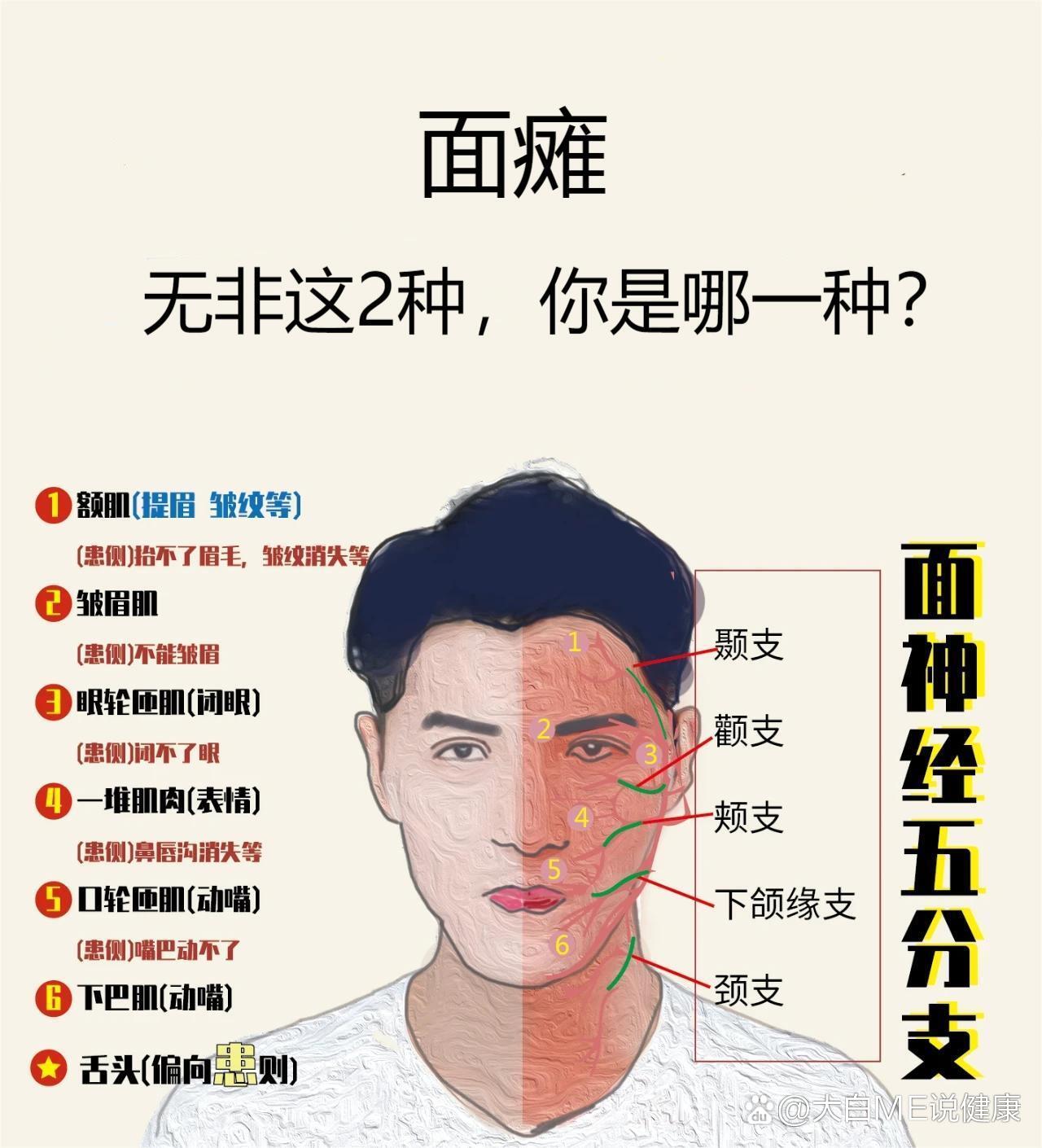 面瘫无非这2种,你是哪一种?