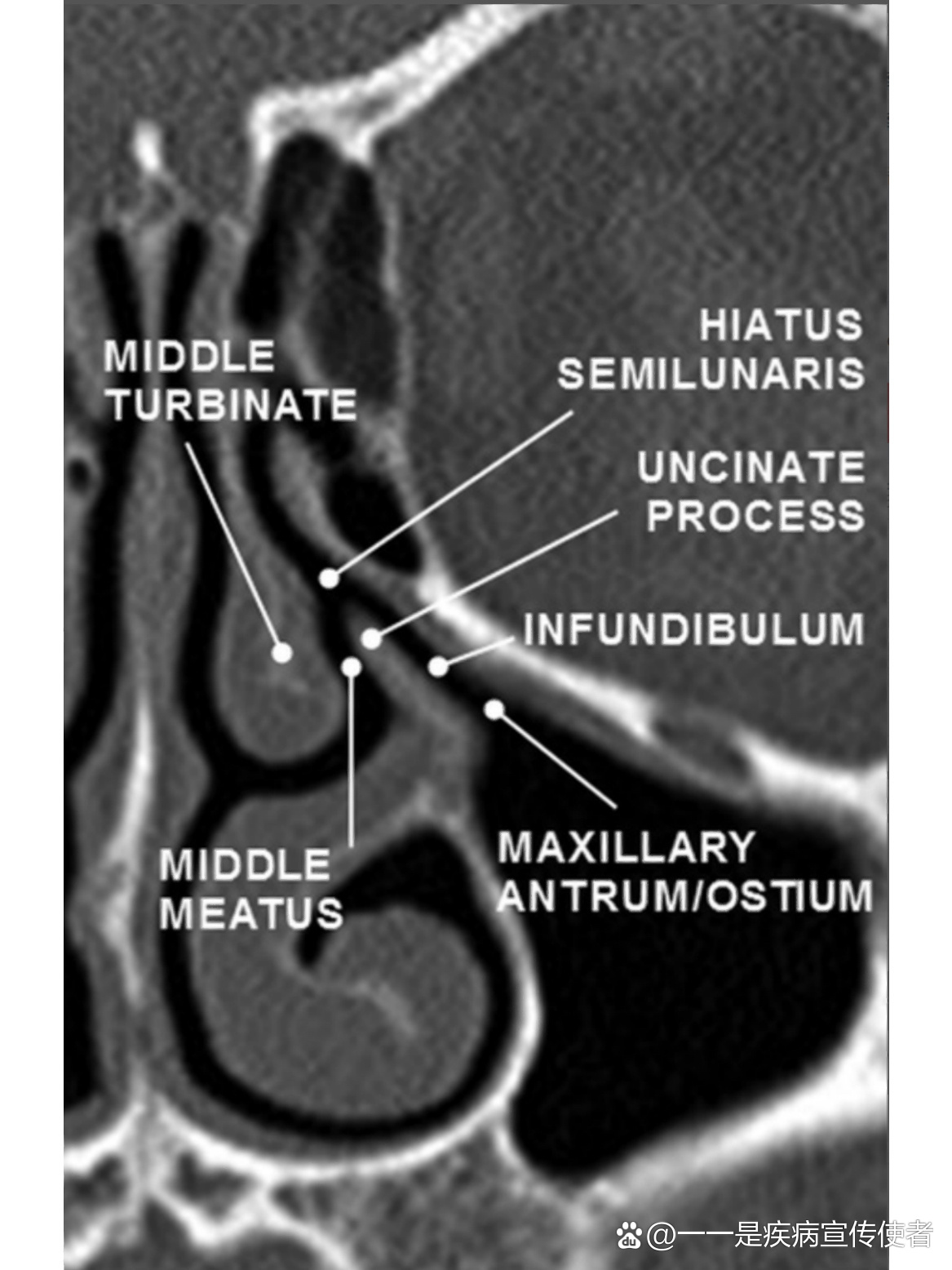 鼻窦钩突图片