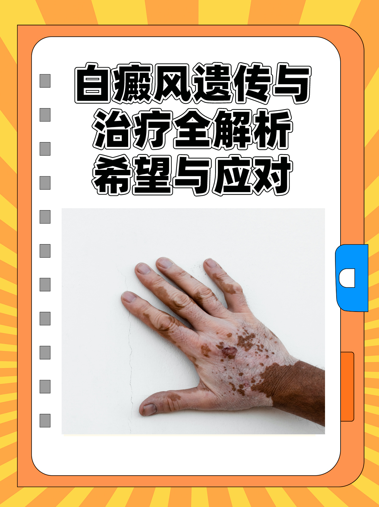 为什么会长白癜风的原因为什么在线 为什么会长白癜风的原因为什么在线