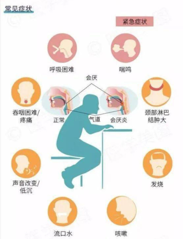 急性会厌炎几天会死亡图片