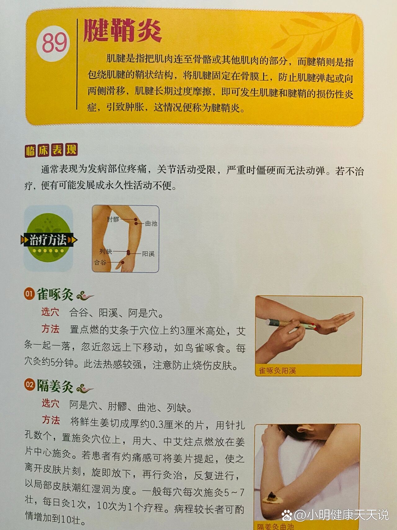 p❤️腱鞘炎br1⃣️雀啄灸br选穴合谷阳溪阿是穴