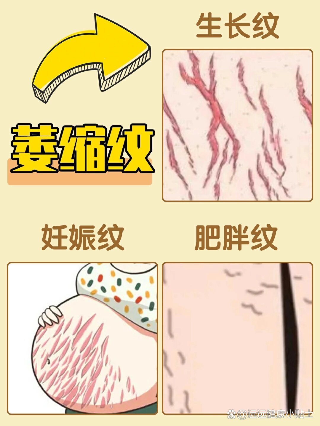 萎缩纹修复攻略75妊娠纹·肥胖纹·生长纹