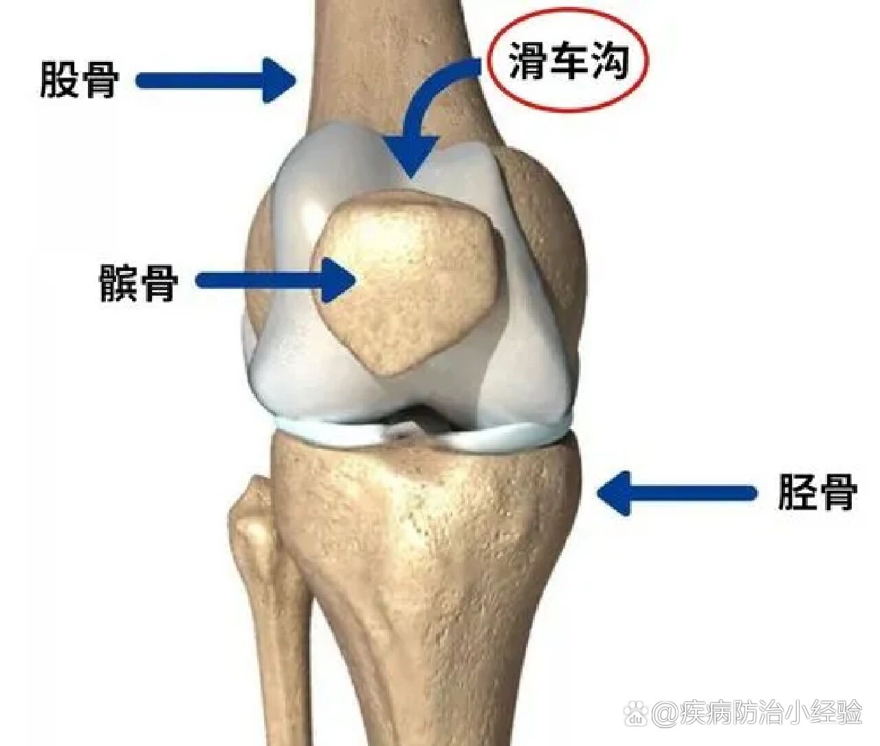 髌骨(patella),俗称膝盖骨,是股四头肌肌腱中形成的一块籽骨,也是全身