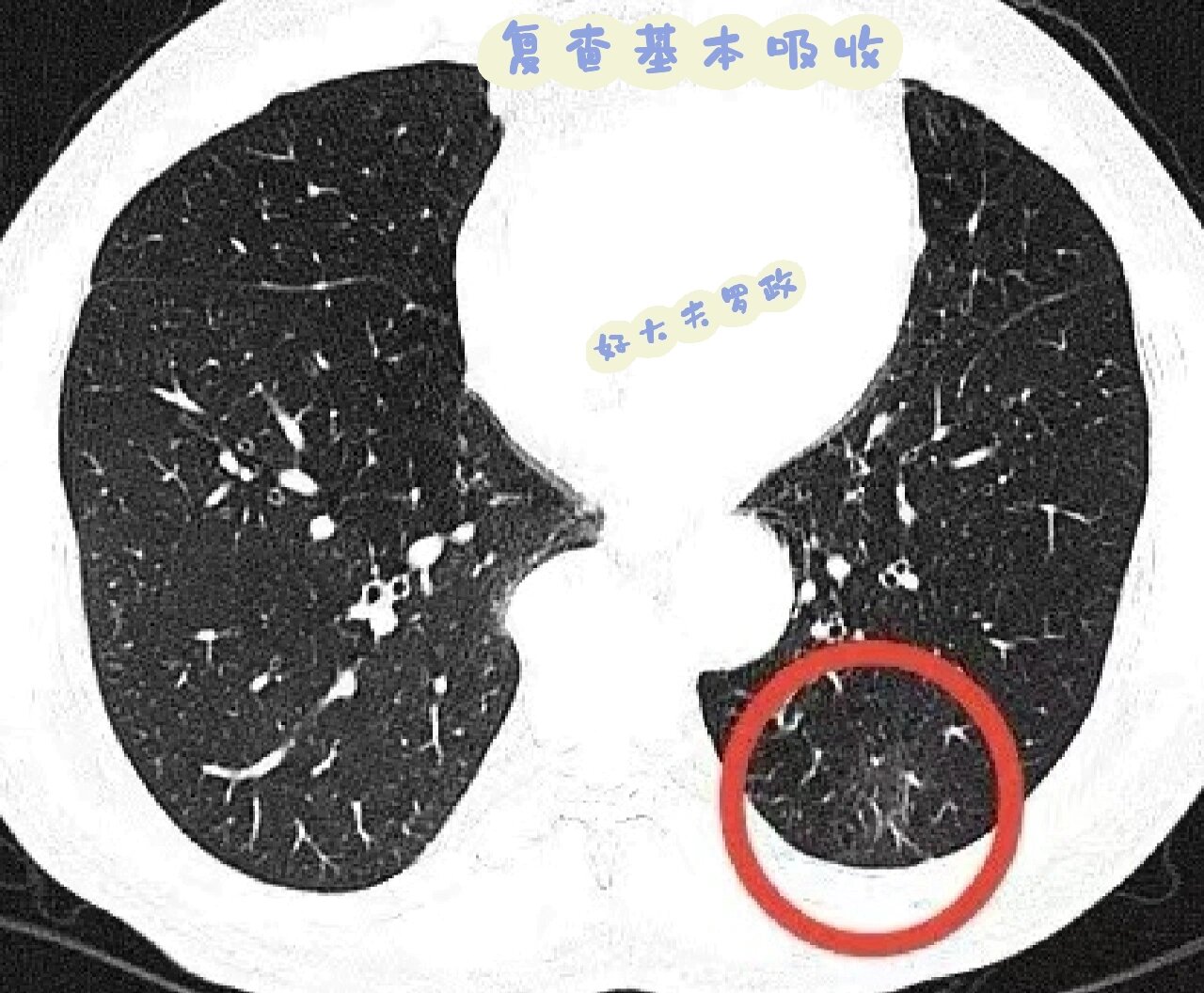 分享一个有毛刺的随访明确性质的肺结节