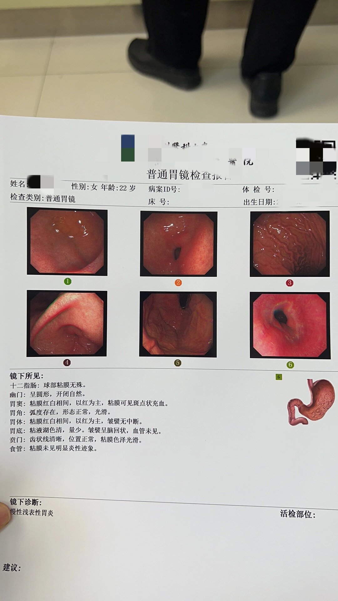 胃镜正常结果图片