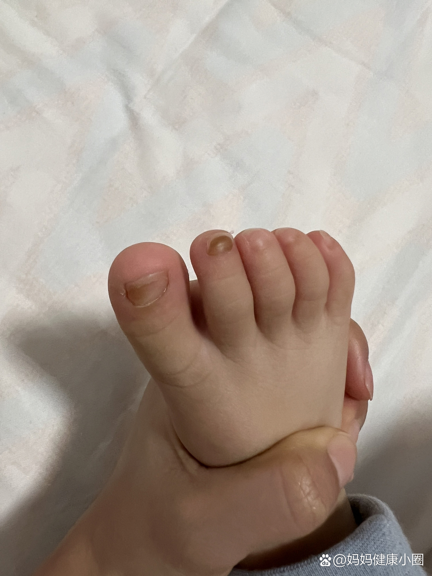 不确定是被砸到了脚丫子,还是灰指甲或是其他原因 