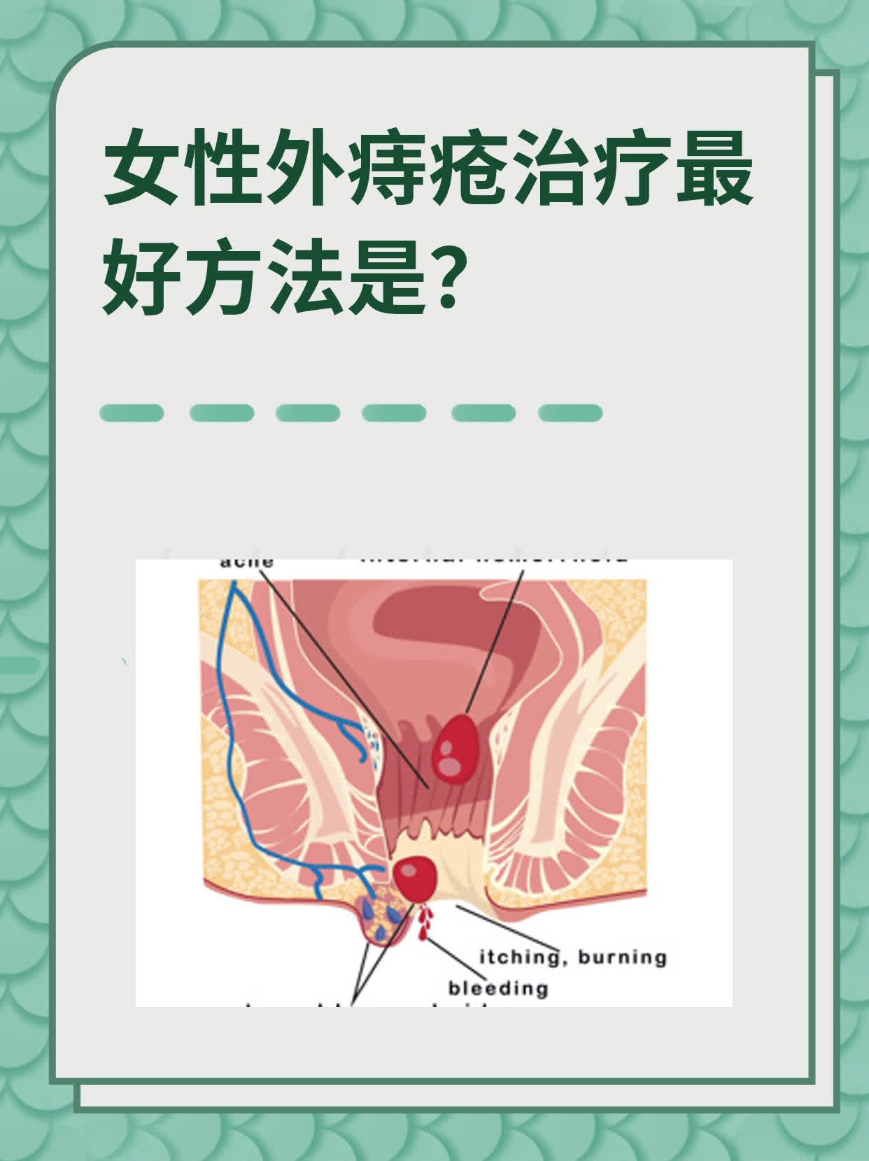 痔疮女性初期图片