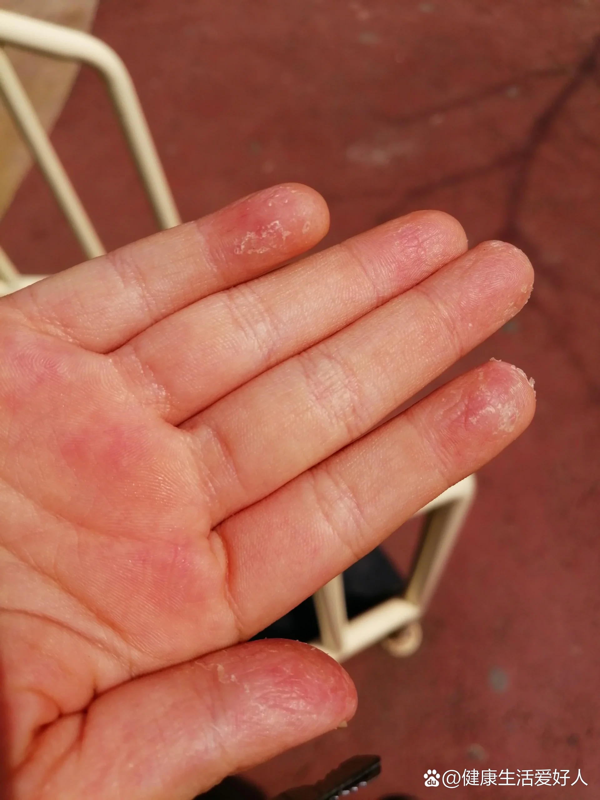非典型性猩红热第十二天,手指全部开始褪皮