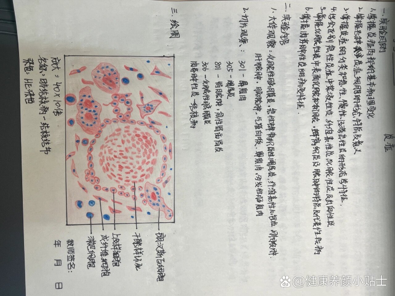 结核结节病理手绘图图片